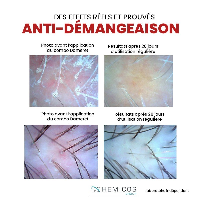Le Duo Anti-démangeaison et Anti-pelliculaire - DAMERET